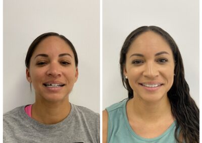 Composite Fillings