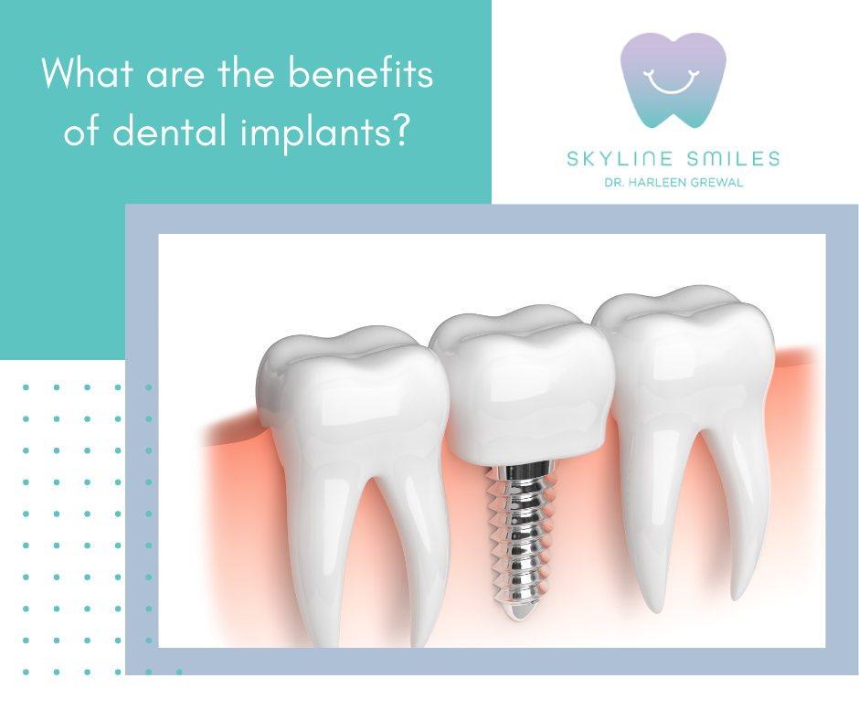 Dental crowns and bridges