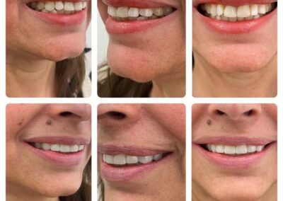 Specialized Frenectomy Services