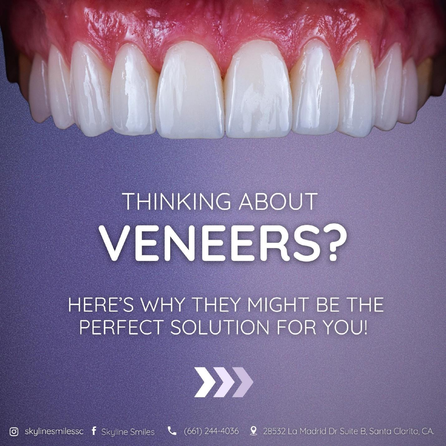 Veneers