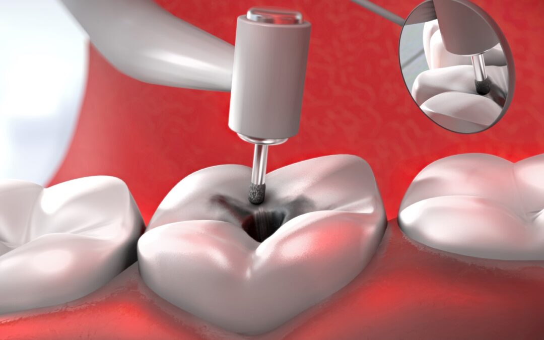 Cavities Without the Drill