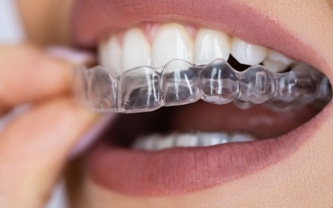 The Essential Guide to Mouth Guards & Night Guards