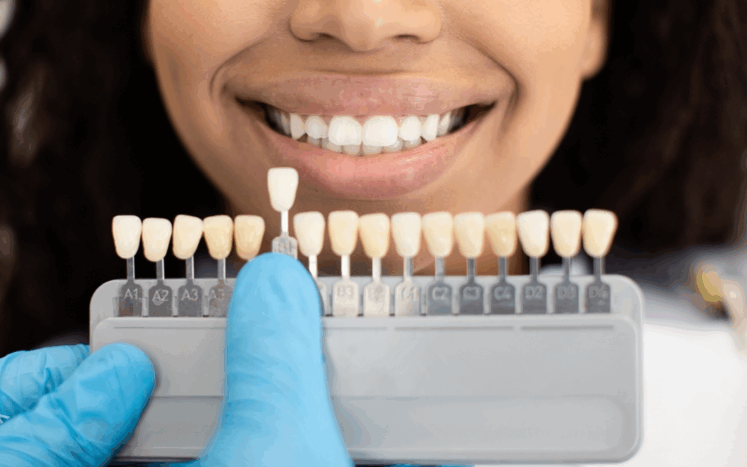 Brightening Beyond Whiteners: When Dental Veneers Become the Ultimate Solution